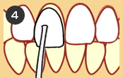 ラミネートベニア治療の流れ 4